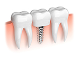 Illustration of a single dental implant in Denver, CO