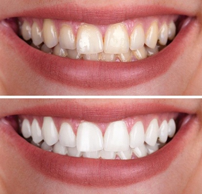 close-up of a person’s smile before and after teeth whitening