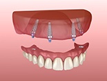 Model of implant-supported upper denture