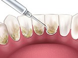 Illustration of scaler cleaning backside of teeth